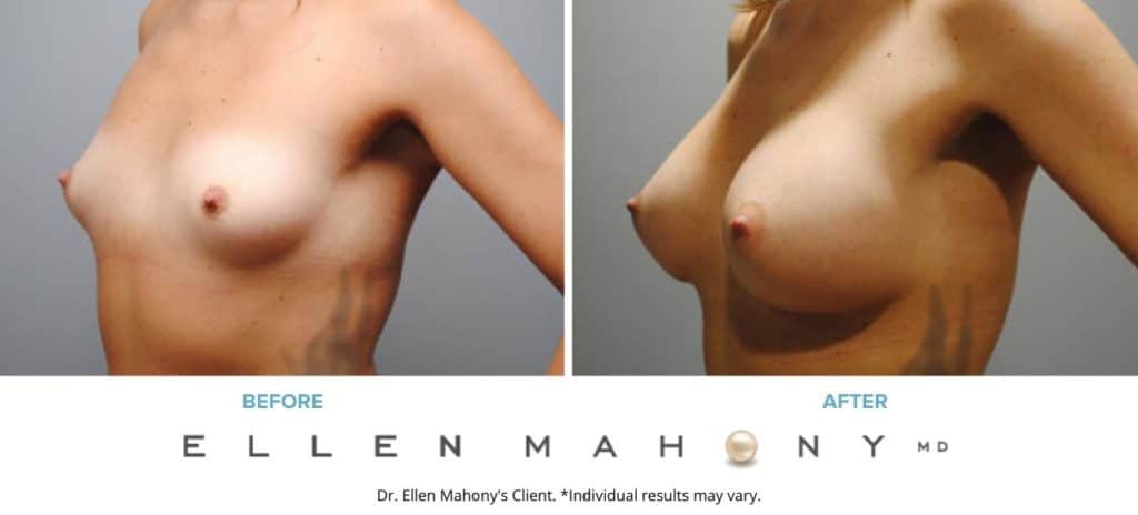 Before and After Image: Case #6103 - left-front-oblique