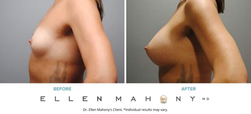Before and After Image: Case #6103 - left-side