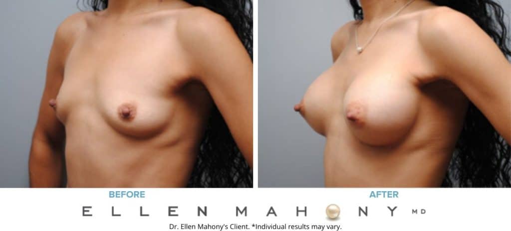 Before and After Image: Case #6236 - left-front-oblique