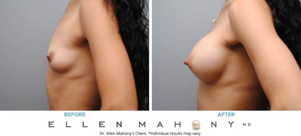 Before and After Image: Case #6236 - left-side