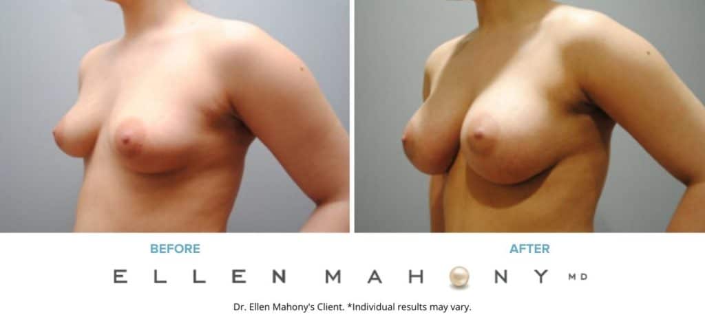 Before and After Image: Case #6267 - left-front-oblique