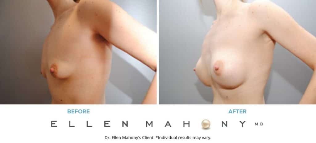 Before and After Image: Case #6275 - left-front-oblique