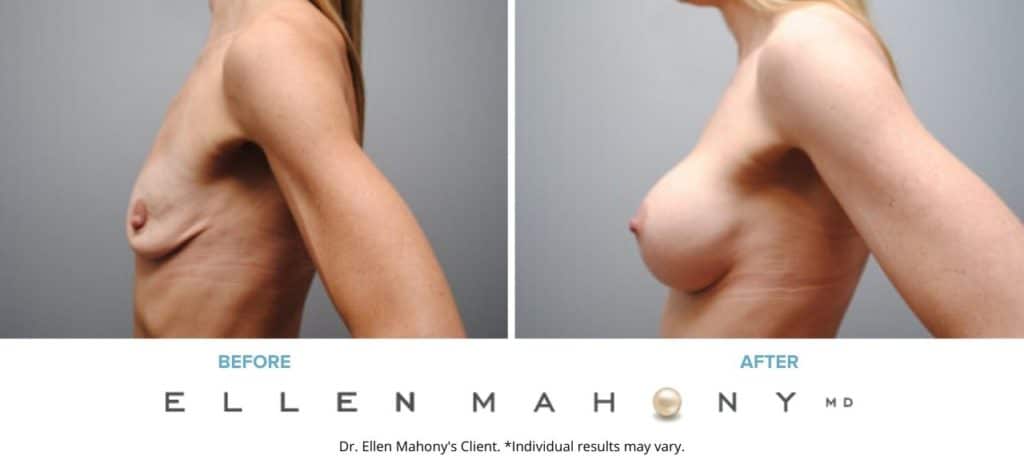 Before and After Image: Case #6287 - left-side