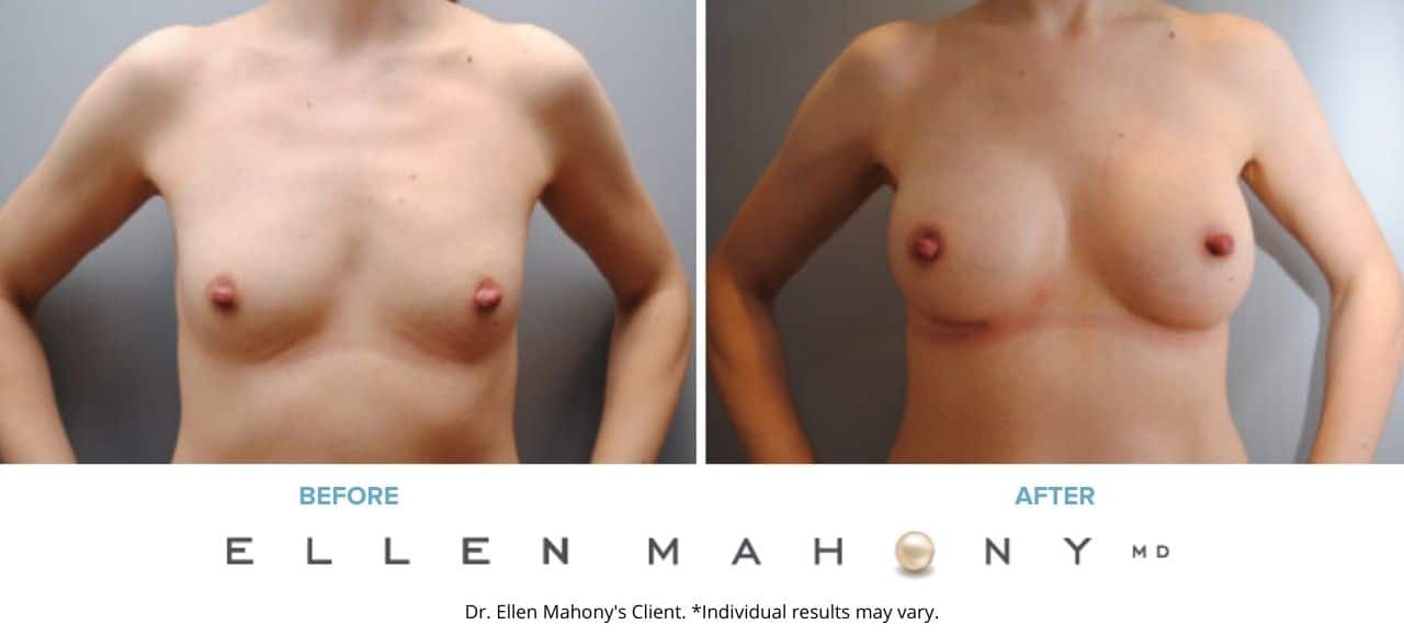 Before and After Image: Case #6324 - front