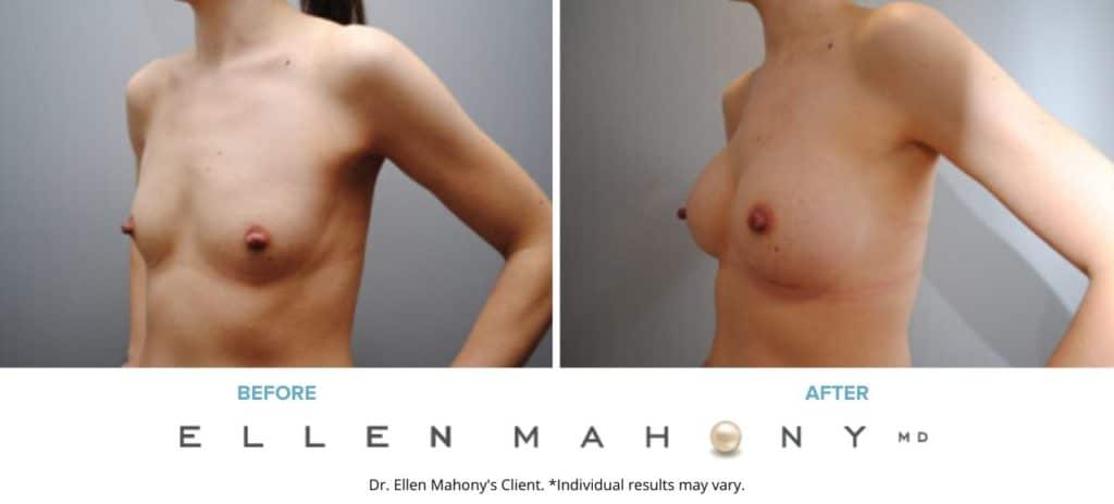 Before and After Image: Case #6324 - left-front-oblique