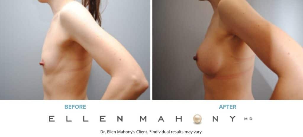 Before and After Image: Case #6324 - left-side
