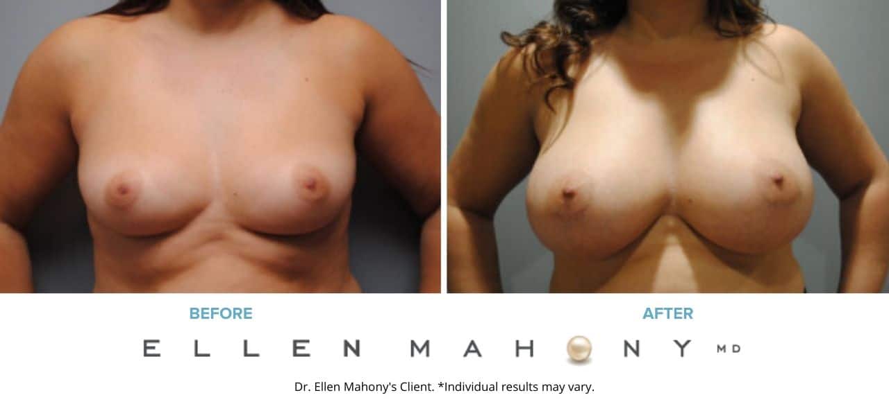 Before and After Image: Case #6336 - front