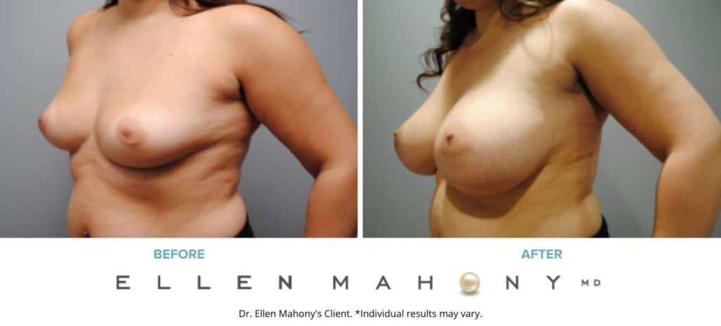 Before and After Image: Case #6336 - left-front-oblique