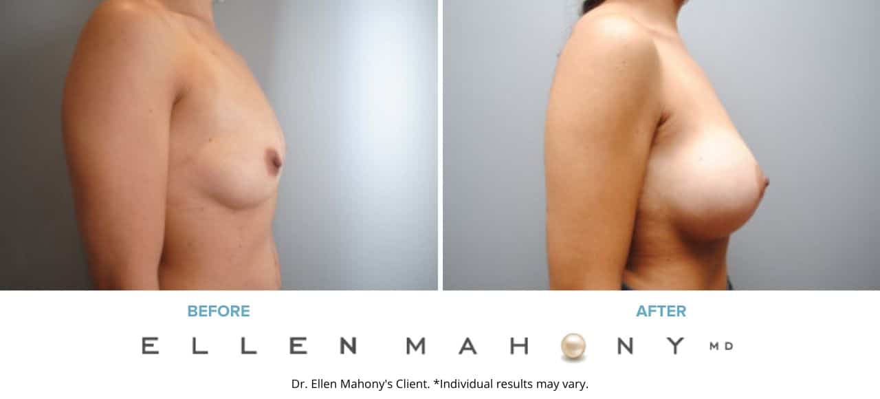 Before and After Image: Case #6344 - right-side