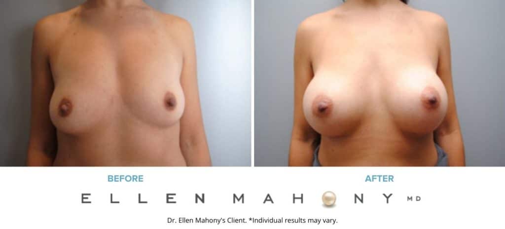 Before and After Image: Case #6344 - front