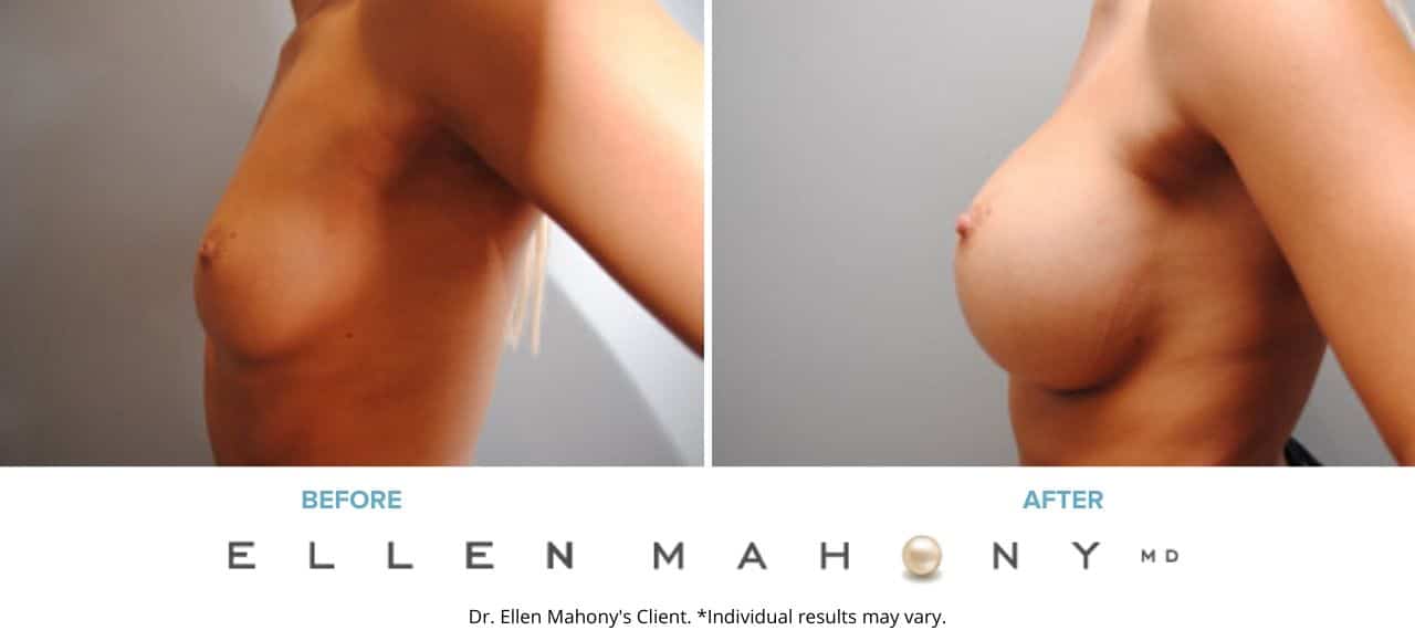 Before and After Image: Case #6440 - left-side