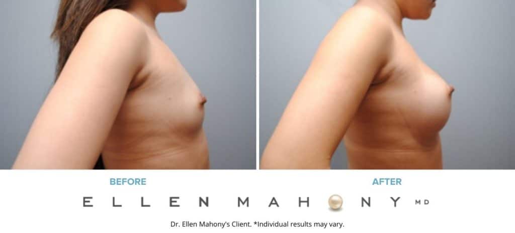 Before and After Image: Case #6491 - right-side
