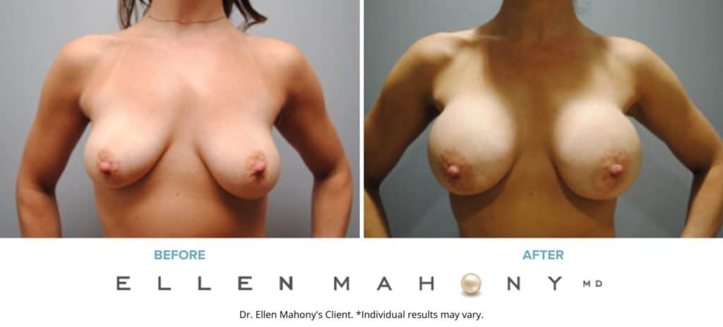 Before and After Image: Case #6819 - front