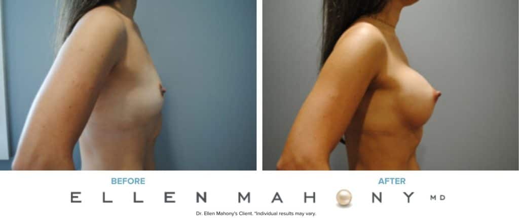 Before and After Image: Case #6920 - right-side