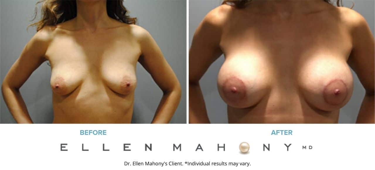 Before and After Image: Case #7206 - front