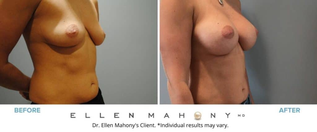 Before and After Image: Case #7310 - right-front-oblique