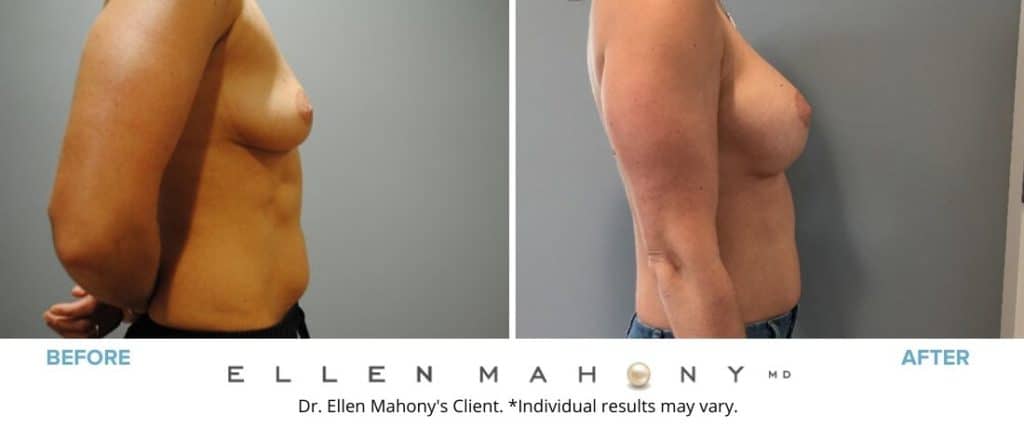 Before and After Image: Case #7310 - right-side