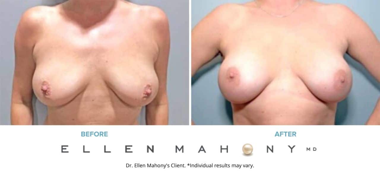 Before and After Image: Case #7387 - front