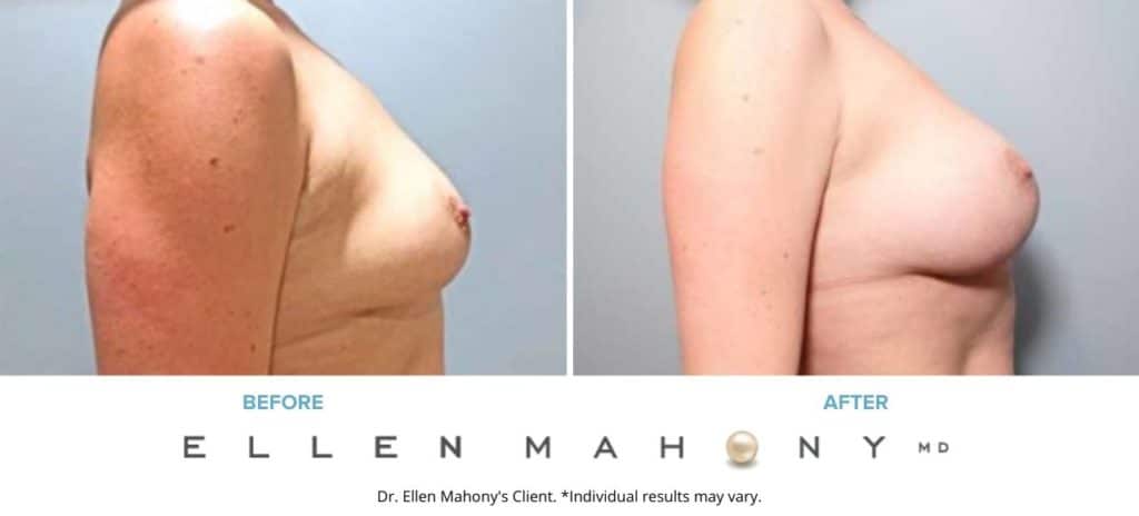Before and After Image: Case #7387 - right-side