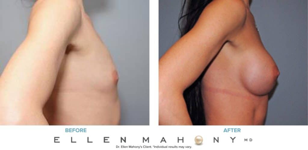 Before and After Image: Case #7571 - right-side