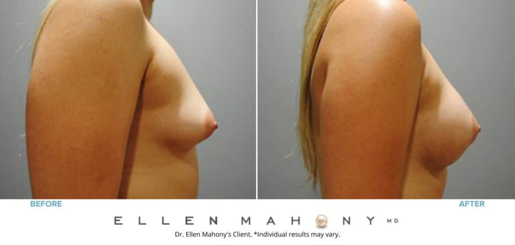 Before and After Image: Case #7742 - right-side