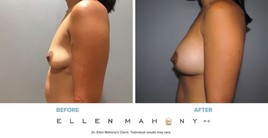 Before and After Image: Case #7750 - left-side