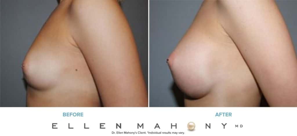 Before and After Image: Case #7898 - left-side