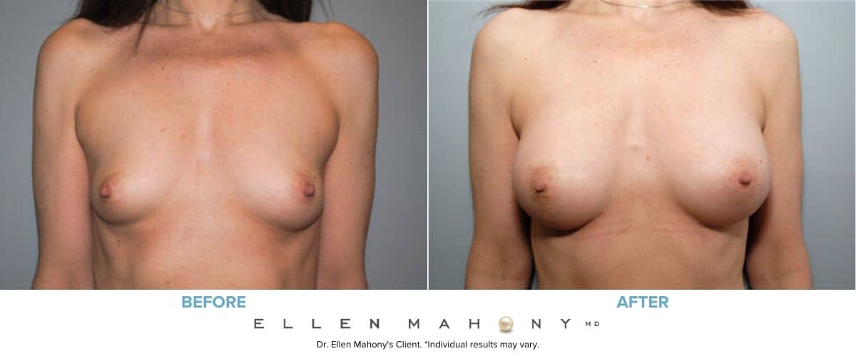 Before and After Image: Case #8040 - front