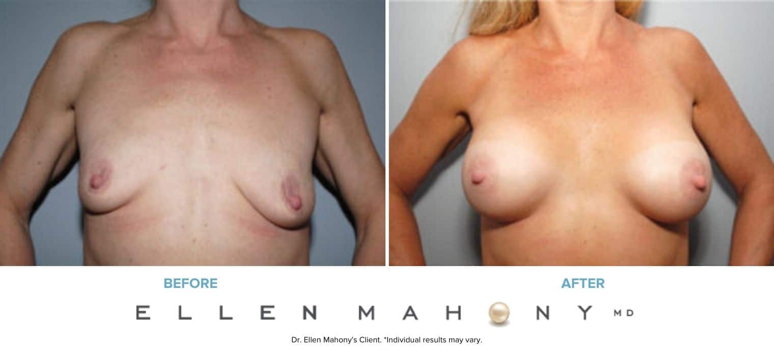 Before and After Image: Case #8048 - front
