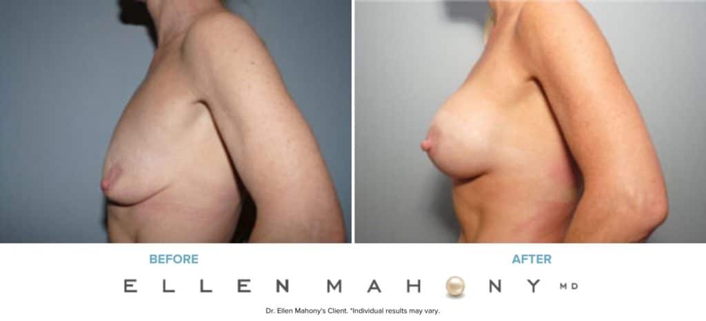 Before and After Image: Case #8048 - left-side
