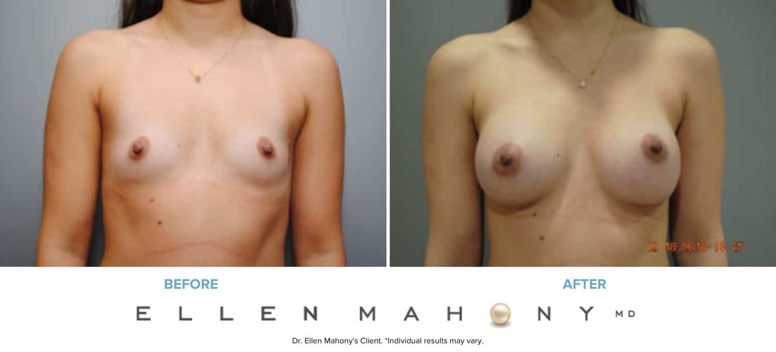 Before and After Image: Case #8692 - front