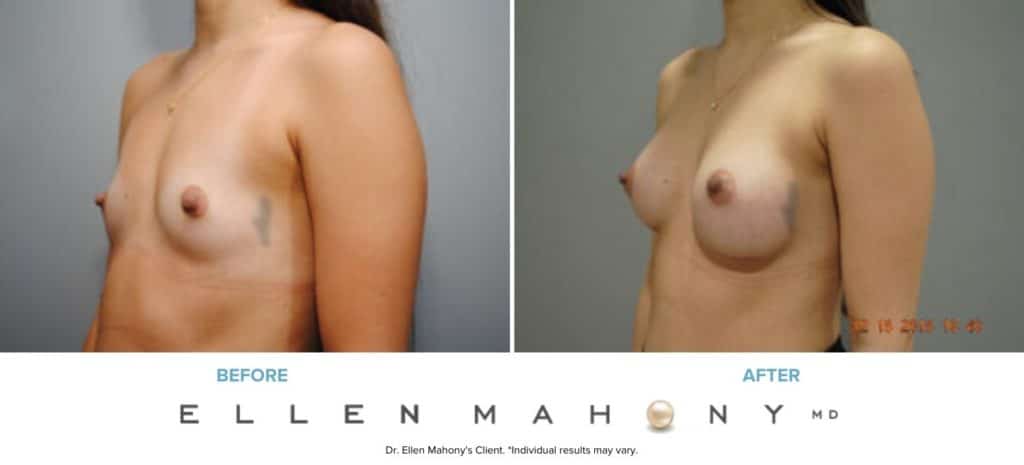 Before and After Image: Case #8692 - left-front-oblique