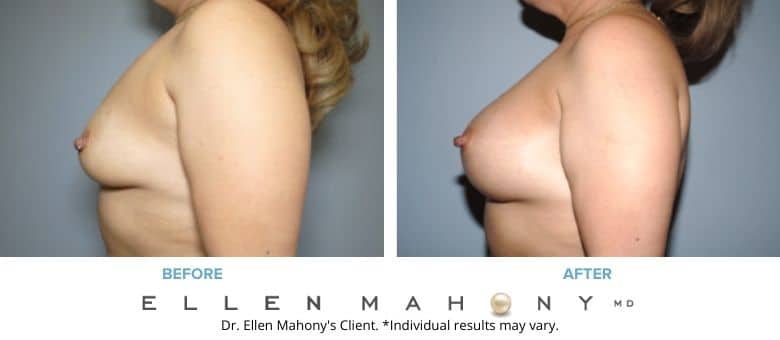 Before and After Image: Case #8751 - left-side