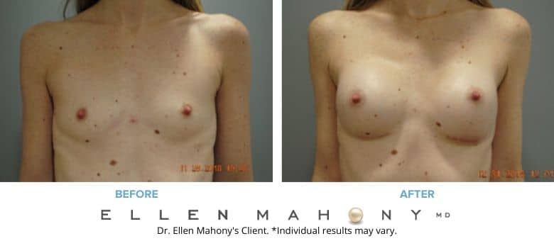 Before and After Image: Case #8765 - front