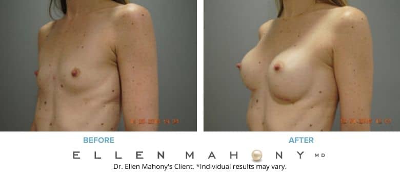 Before and After Image: Case #8765 - left-front-oblique
