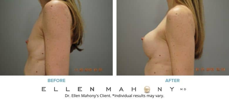 Before and After Image: Case #8765 - left-side