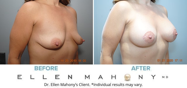 Before and After Image: Case #8255-2 - right-front-oblique