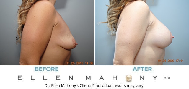 Before and After Image: Case #8255-2 - right-side