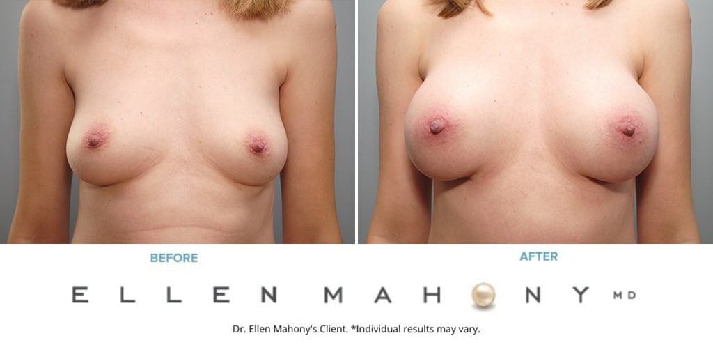 Before and After Image: Case #9054 - front