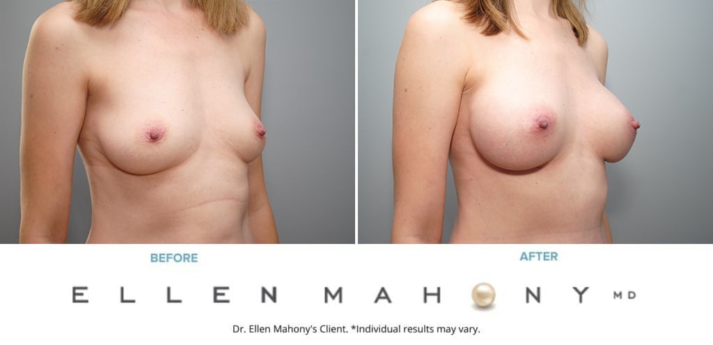 Before and After Image: Case #9054 - right-front-oblique
