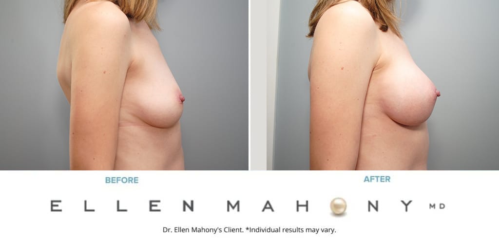 Before and After Image: Case #9054 - right-side