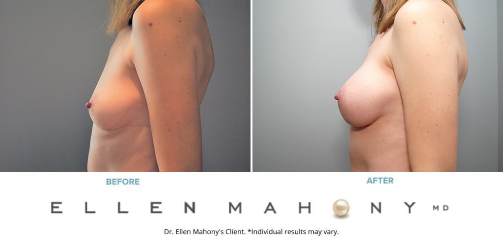 Before and After Image: Case #9054 - left-side