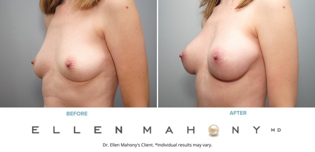Before and After Image: Case #9054 - left-front-oblique