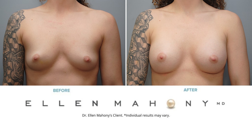 Before and After Image: Case #9088 - front