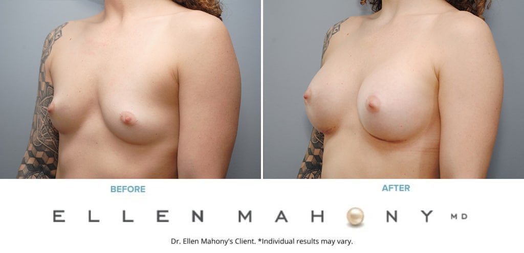 Before and After Image: Case #9088 - left-front-oblique
