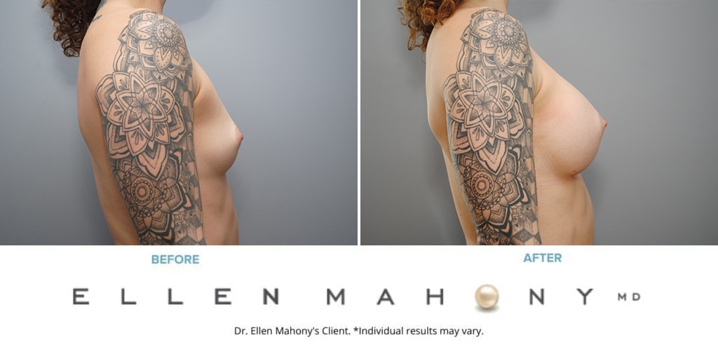 Before and After Image: Case #9088 - right-side