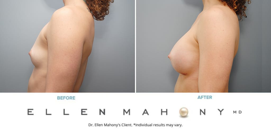 Before and After Image: Case #9088 - left-side