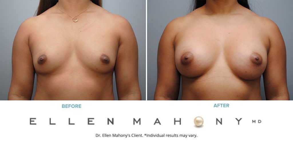 Before and After Image: Case #9331 - front