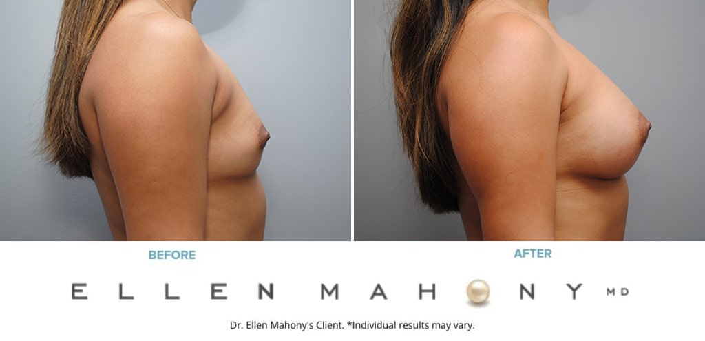 Before and After Image: Case #9331 - right-side