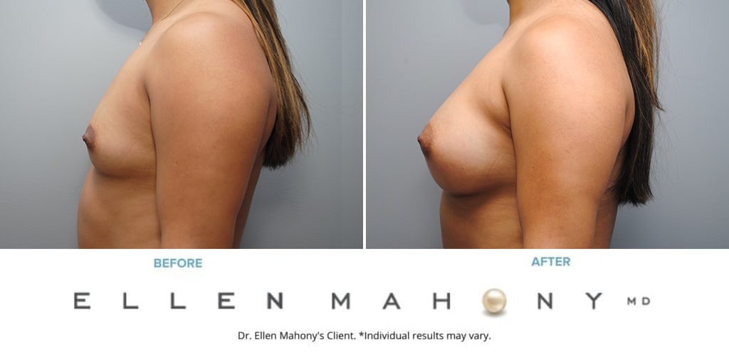 Before and After Image: Case #9331 - left-side